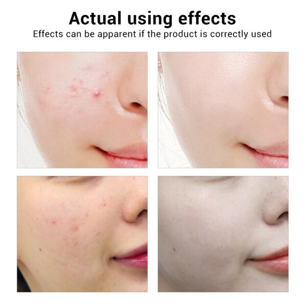 BREYLEE Acne Treatment Face Serum Mask Anti Acne Pimple Scar Remover Moisturizing Whitening Skin Care Facial Essence Cream 17ml - Image 3